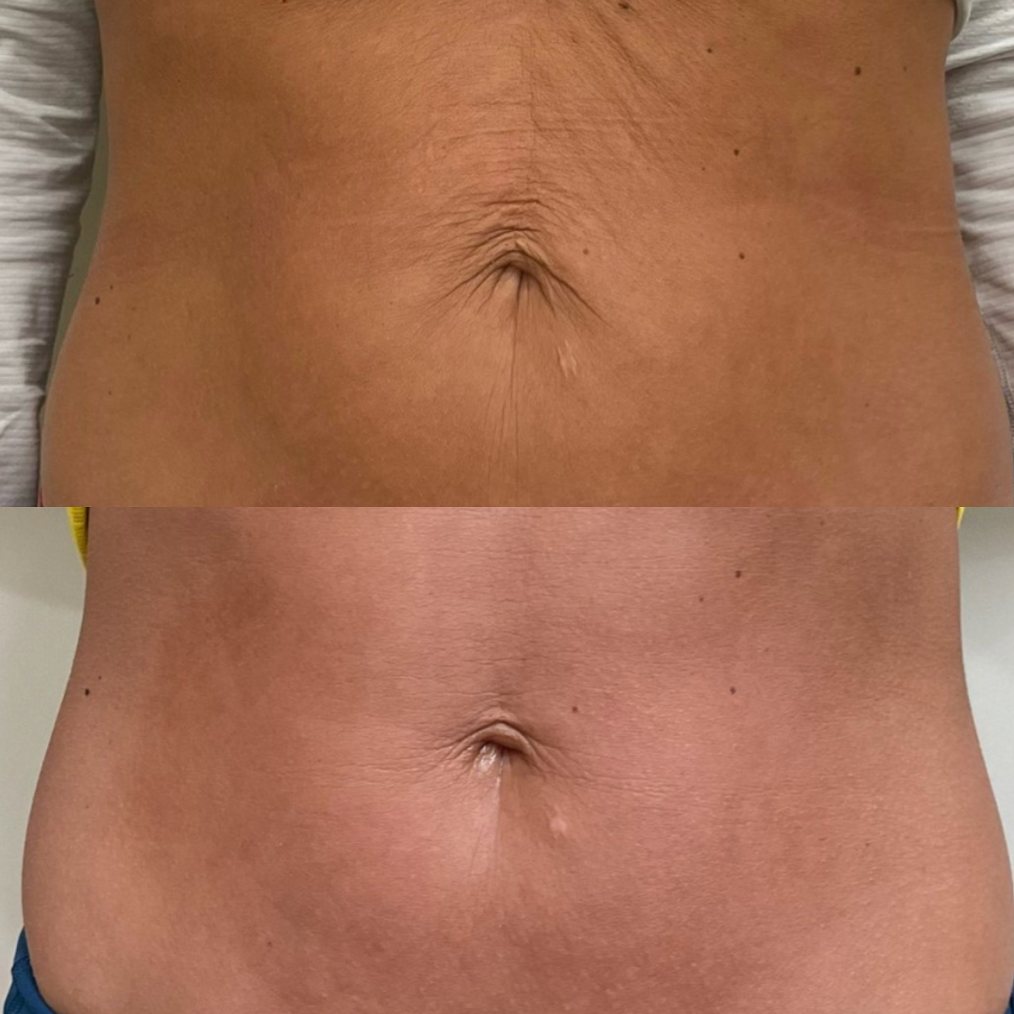 Read more about the article Bauchstraffung nach Operation: Wie Morpheus8 die Haut glättet und perfektioniert
