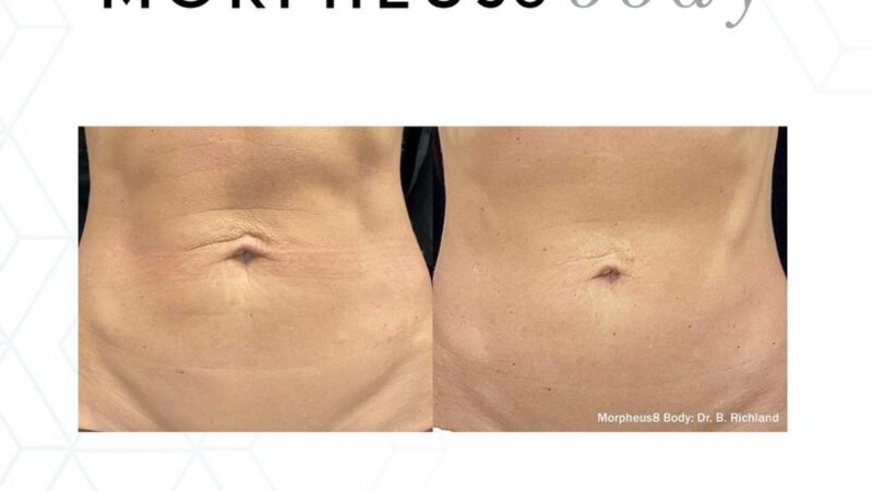 Morpheus8 in Frankfurt am Main: Der Anti-Aging Gamechanger, den Businessfrauen lieben