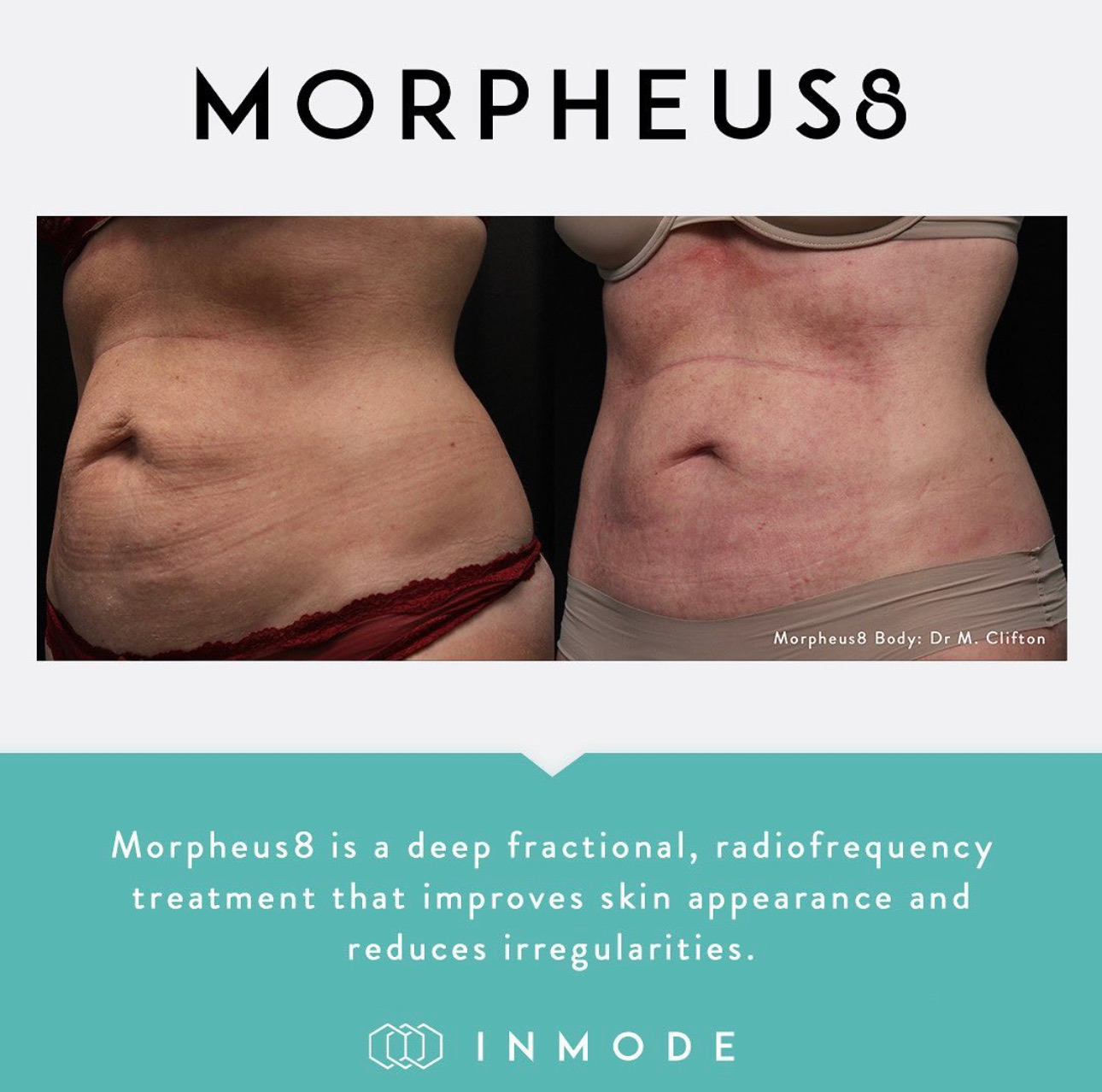 Read more about the article Schwangerschaftsstreifen effektiv entfernen: Der Morpheus8-Weg in Frankfurt am Main